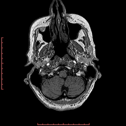Choroid plexus xanthogranuloma (Radiopaedia 67843-77270 Axial T1 142).jpg