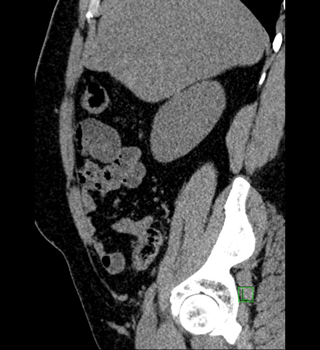 Chromophobe renal cell carcinoma (Radiopaedia 84286-99573 C 135).jpg