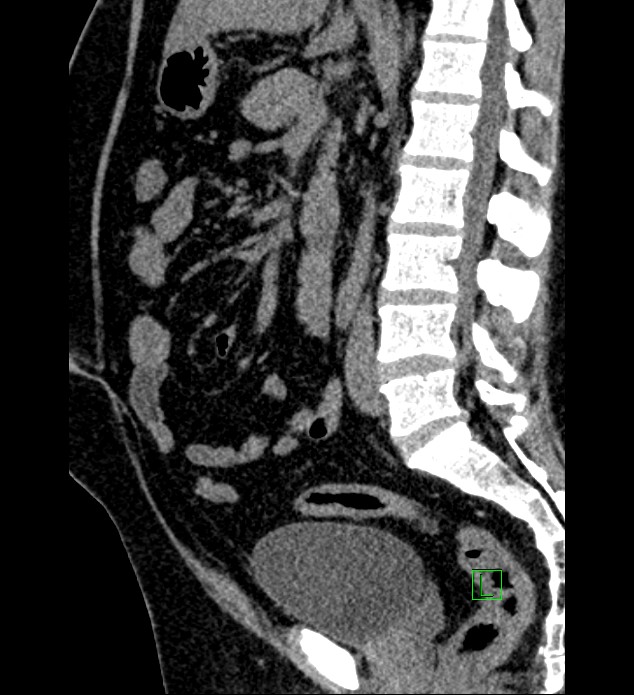 Chromophobe renal cell carcinoma (Radiopaedia 84286-99573 C 89).jpg
