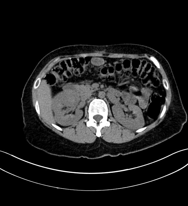 Chromophobe renal cell carcinoma (Radiopaedia 84290-99582 Axial non-contrast 54).jpg