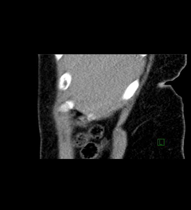 Chromophobe renal cell carcinoma (Radiopaedia 84290-99582 D 88).jpg