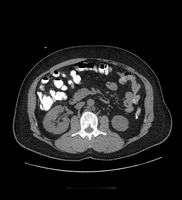 Chromophobe renal cell carcinoma (Radiopaedia 84337-99644 Axial non-contrast 46).jpg