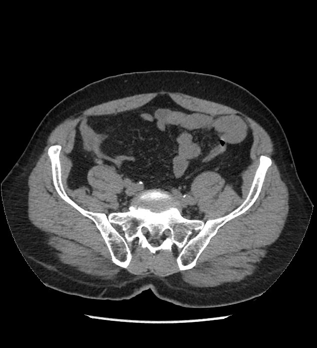 Chromophobe renal cell carcinoma (Radiopaedia 86879-103083 Axial non-contrast 93).jpg