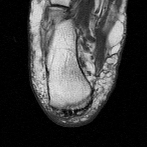 File:Chronic Achilles tendon rupture (Radiopaedia 15262-15100 Axial T1 27).jpg
