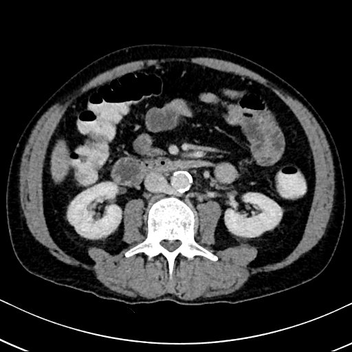 Chronic appendicitis complicated by appendicular abscess, pylephlebitis and liver abscess (Radiopaedia 54483-60700 B 76).jpg