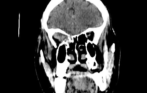 Chronic invasive fungal sinusitis (Radiopaedia 91563-109286 D 50).jpg