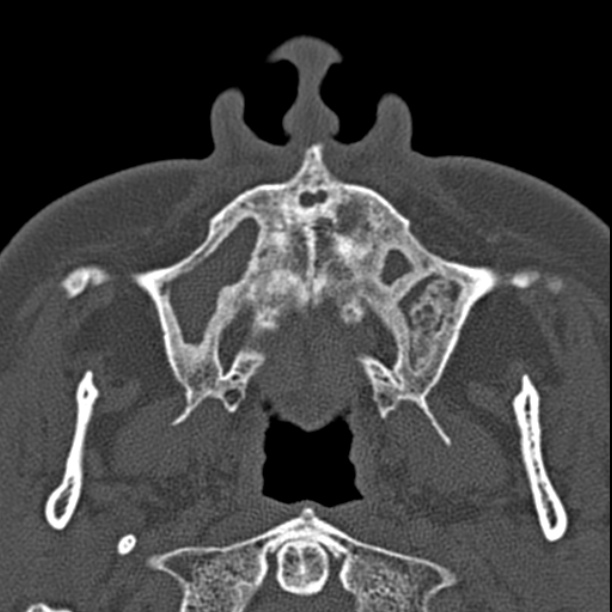 Chronic maxillary sinusitis (Radiopaedia 27879-28116 Axial bone window 7).jpg