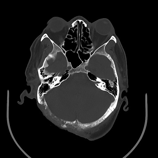 Chronic osteomyelitis - calvarial (severe) (Radiopaedia 69668-79616 Axial bone window 33).jpg