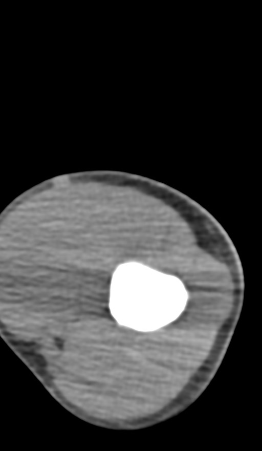 Chronic osteomyelitis of the distal humerus (Radiopaedia 78351-90971 Axial non-contrast 54).jpg