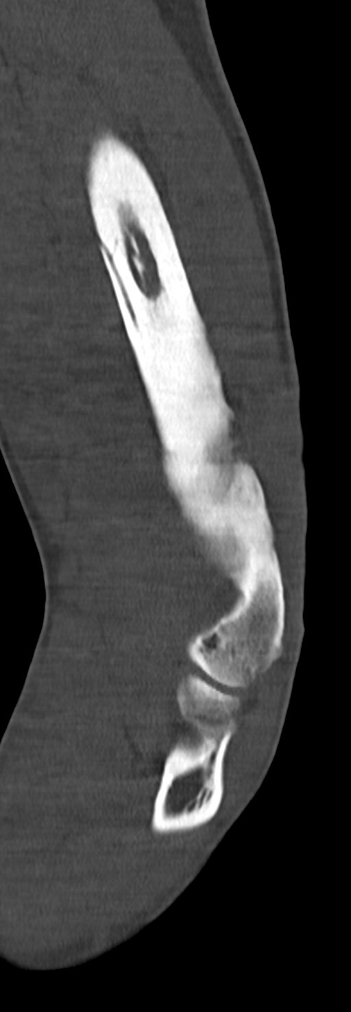 Chronic osteomyelitis of the distal humerus (Radiopaedia 78351-90971 Sagittal bone window 47).jpg