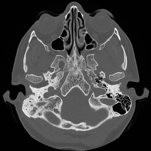 File:Chronic otomastoiditis (Radiopaedia 27138-27309 Axial bone window 14).jpg