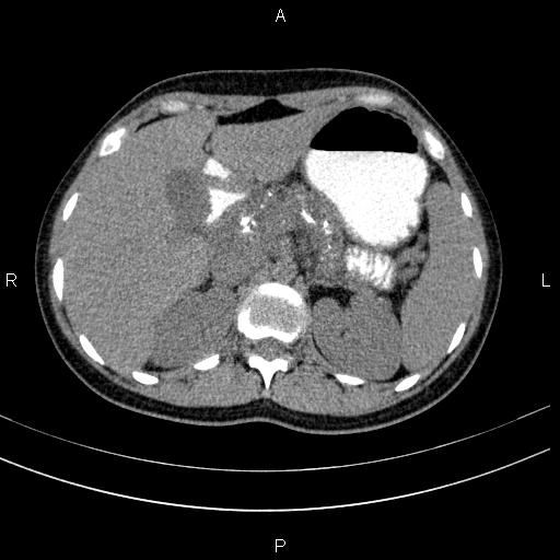 Chronic pancreatitis (Radiopaedia 64576-73450 Axial non-contrast 39).jpg