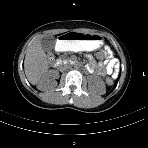 Chronic pancreatitis (Radiopaedia 64576-73450 Axial non-contrast 61).jpg