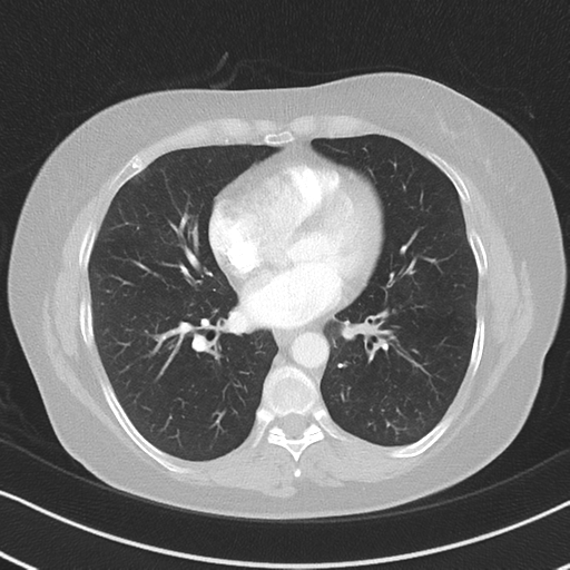 Chronic pulmonary embolus (Radiopaedia 39129-41341 Axial lung window 38).png