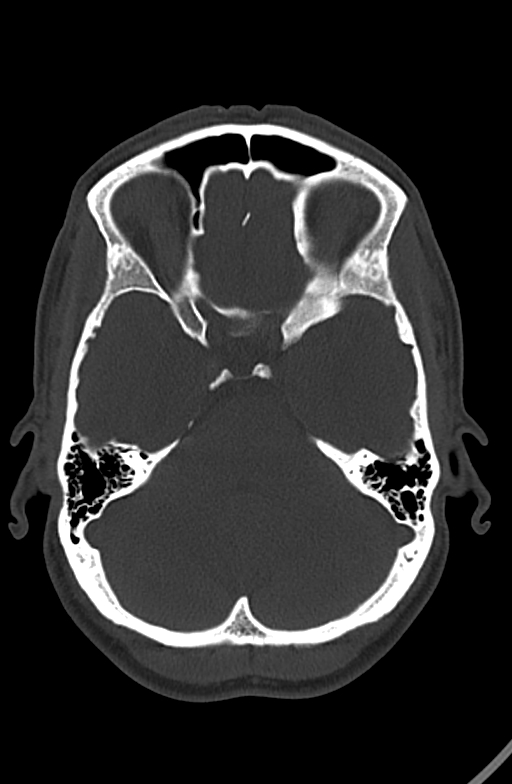 Chronic secondary hypoparathyroidism (Radiopaedia 74645-85601 Axial bone window 72).jpg