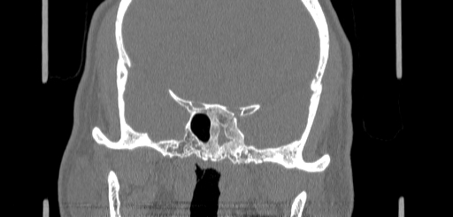 Chronic sphenoidal sinusitis (Radiopaedia 62030-70122 Coronal bone window 122).jpg