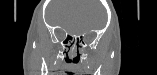 Chronic sphenoidal sinusitis (Radiopaedia 62030-70122 Coronal bone window 89).jpg