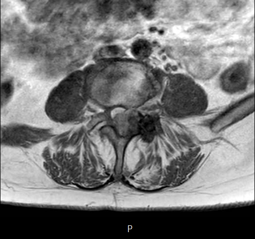 File:Chronic spinal hematoma with cauda equina syndrome (Radiopaedia 75745-87090 Axial T1 19).png