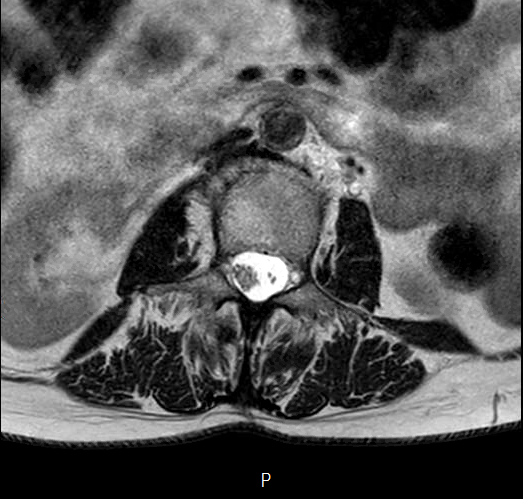 File:Chronic spinal hematoma with cauda equina syndrome (Radiopaedia 75745-87090 Axial T2 1).png