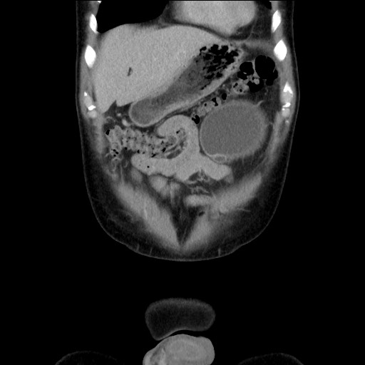 Chronic ureteropelvic junction obstruction (Radiopaedia 78365-90996 B 22).jpg
