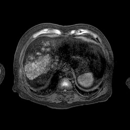Cirrhosis and hepatocellular carcinoma in the setting of hemochromatosis (Radiopaedia 75394-86594 Axial T1 C+ fat sat 63).jpg