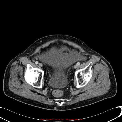 Cirrhosis and hepatocellular carcinoma in the setting of hemochromatosis (Radiopaedia 75394-86595 B 76).jpg