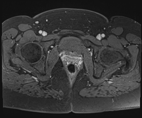 File:Class II Mullerian duct anomaly- unicornuate uterus with rudimentary horn and non-communicating cavity (Radiopaedia 39441-41755 Axial T1 fat sat 112).jpg