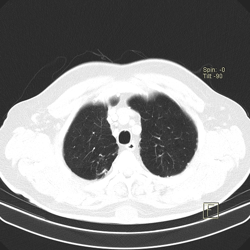 Classic complicated silicosis (Radiopaedia 49720-54961 Axial lung window 9).jpg