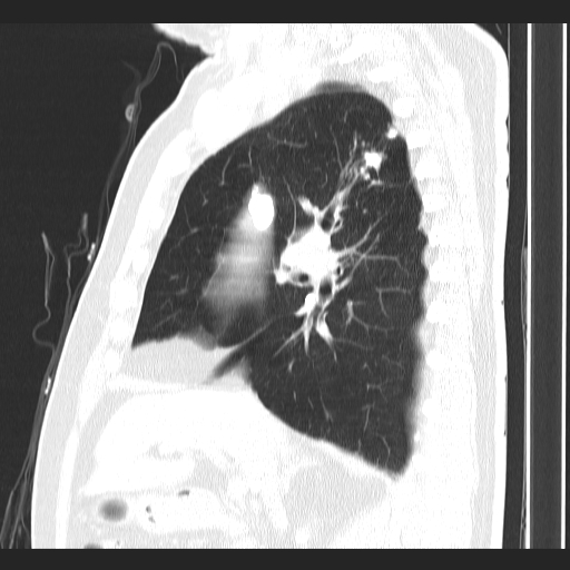File:Classic complicated silicosis (Radiopaedia 49720-54961 Sagittal lung window 39).jpg