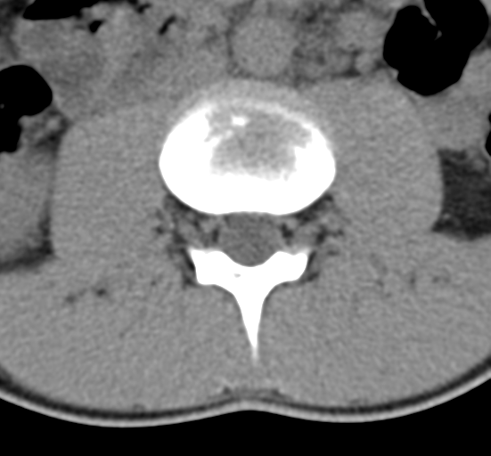 Clear cell meningoma - lumbar spine (Radiopaedia 60116-67691 Axial non-contrast 30).png