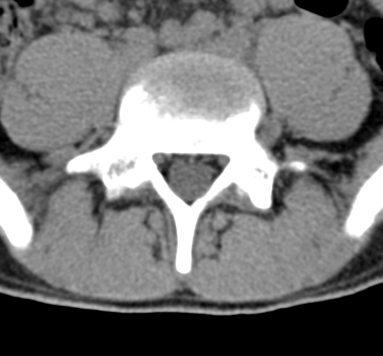 Clear cell meningoma - lumbar spine (Radiopaedia 60116-67691 Axial non-contrast 58).png