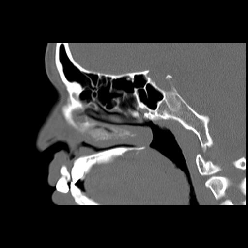 Cleft hard palate and alveolus (Radiopaedia 63180-71710 Sagittal bone window 23).jpg
