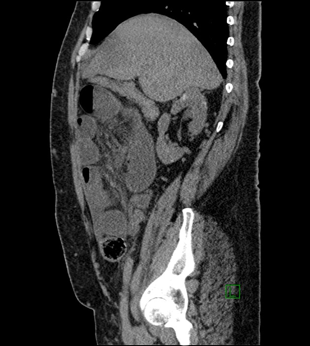 Closed-loop small bowel obstruction-internal hernia (Radiopaedia 78439-91096 C 100).jpg