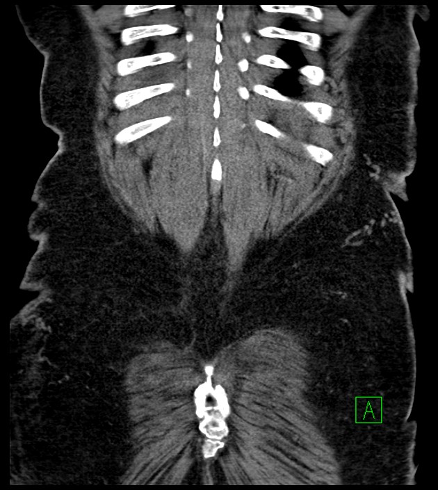 Closed-loop small bowel obstruction-internal hernia (Radiopaedia 78439-91096 Coronal non-contrast 91).jpg