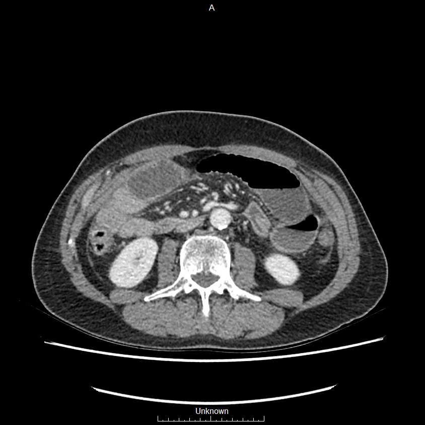 Closed loop bowel obstruction and ischemia (Radiopaedia 86959-103180 A 38).jpg