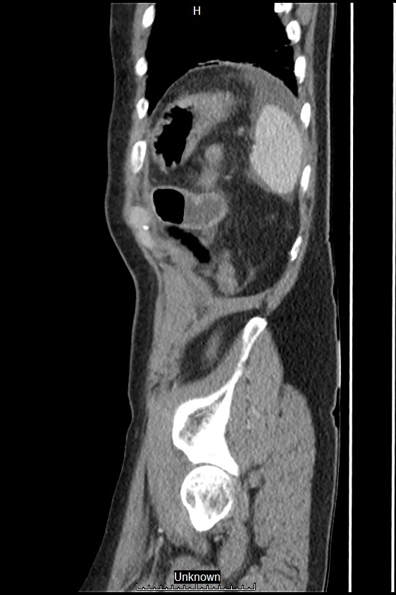 Closed loop bowel obstruction and ischemia (Radiopaedia 86959-103180 C 5).jpg