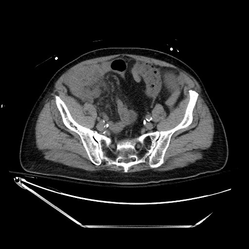File:Closed loop obstruction due to adhesive band, resulting in small bowel ischemia and resection (Radiopaedia 83835-99023 Axial non-contrast 118).jpg