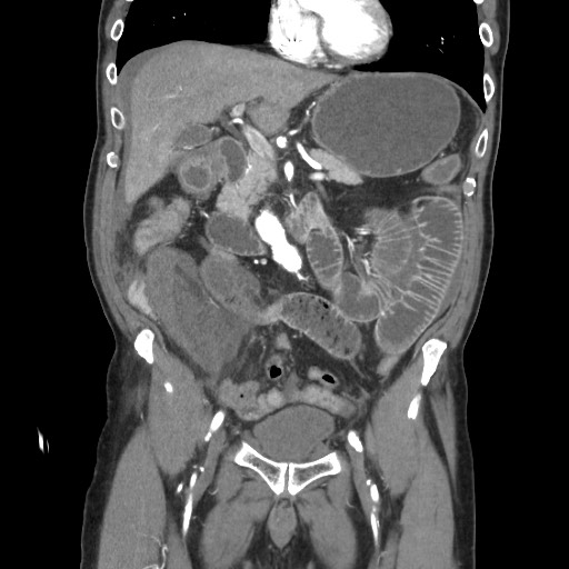 Closed loop obstruction due to adhesive band, resulting in small bowel ischemia and resection (Radiopaedia 83835-99023 C 54).jpg