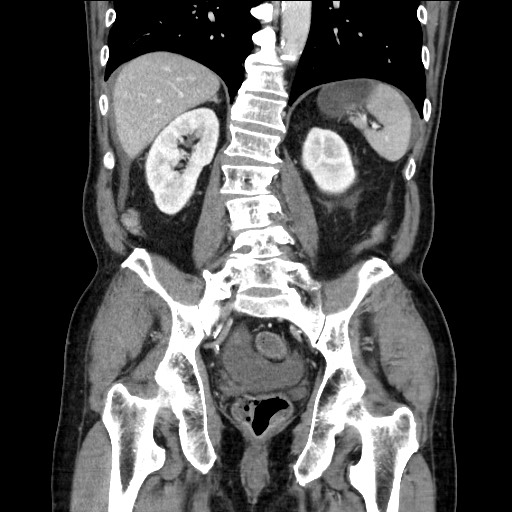 Closed loop obstruction due to adhesive band, resulting in small bowel ischemia and resection (Radiopaedia 83835-99023 E 88).jpg