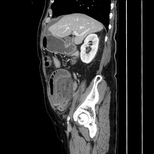 File:Closed loop obstruction due to adhesive band, resulting in small bowel ischemia and resection (Radiopaedia 83835-99023 F 63).jpg