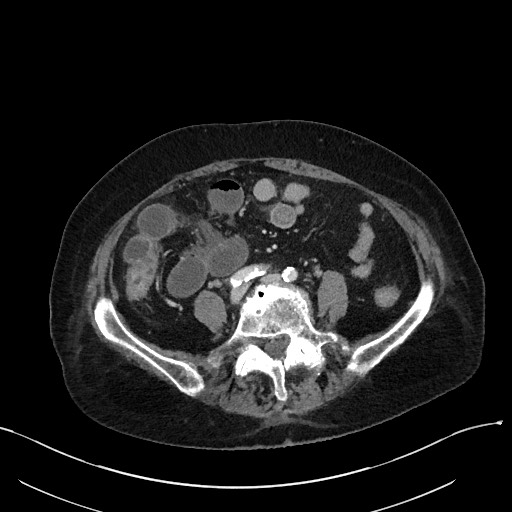 File:Closed loop small bowel obstruction - adhesions (Radiopaedia 59269-66611 Axial 14).jpg
