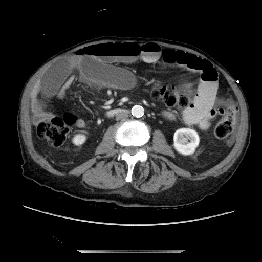 File:Closed loop small bowel obstruction - adhesive disease and hemorrhagic ischemia (Radiopaedia 86831-102990 A 98).jpg