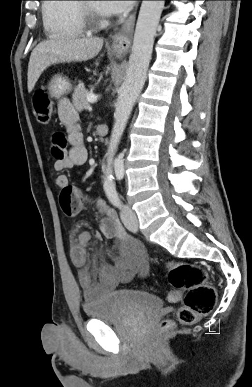 Closed loop small bowel obstruction - internal hernia (Radiopaedia 57806-64778 C 54).jpg