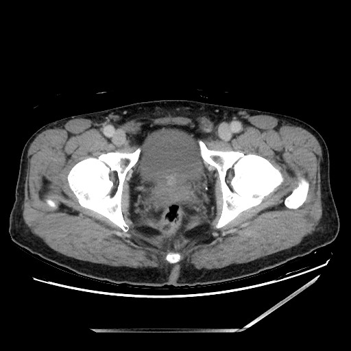 Closed loop small bowel obstruction - omental adhesion causing "internal hernia" (Radiopaedia 85129-100682 A 163).jpg