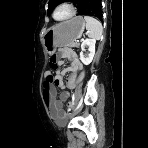 File:Closed loop small bowel obstruction due to adhesive band, with intramural hemorrhage and ischemia (Radiopaedia 83831-99017 D 136).jpg