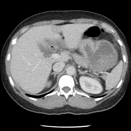 File:Closed loop small bowel obstruction due to trans-omental herniation (Radiopaedia 35593-37109 A 27).jpg