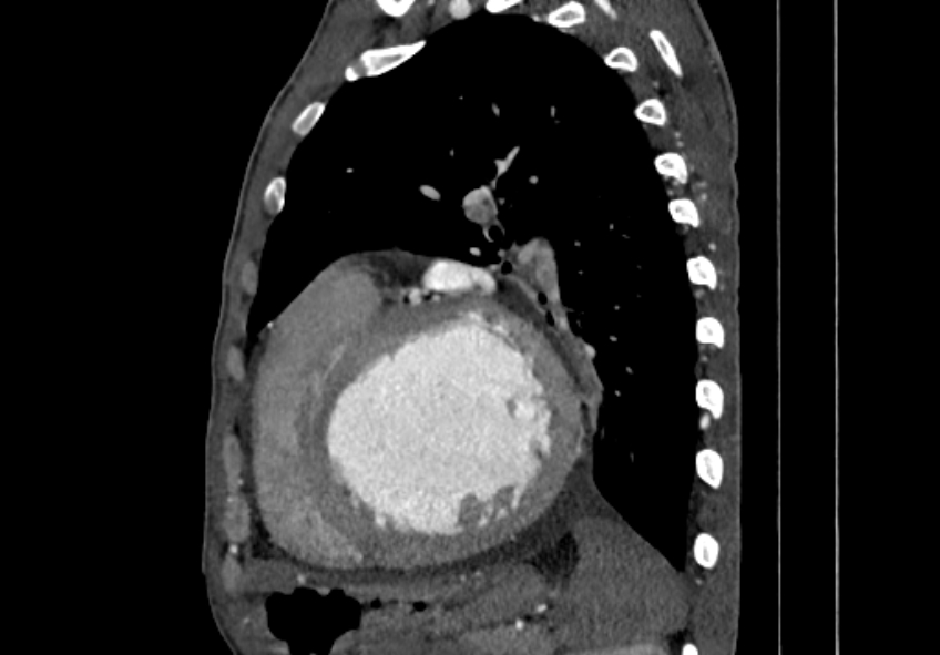 Coarctation of aorta with aortic valve stenosis (Radiopaedia 70463-80574 B 135).jpg
