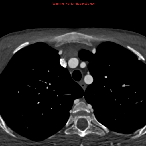 File:Coarctation of the aorta (Radiopaedia 12461-12697 A 10).jpg