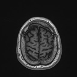 File:Cochlear incomplete partition type III associated with hypothalamic hamartoma (Radiopaedia 88756-105498 Axial T1 169).jpg