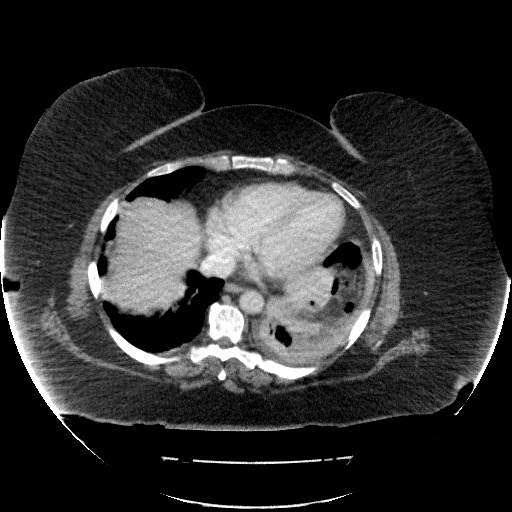 File:Collection due to leak after sleeve gastrectomy (Radiopaedia 55504-61972 A 11).jpg